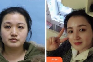 東陽麗萊醫(yī)療美容醫(yī)院吳大毛整形價(jià)格表附鼻部綜合案例展示