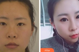 東陽市人民醫(yī)院整形外科金凱頻整形價(jià)格表附鼻部綜合案例展示