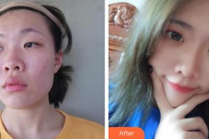 東陽市人民醫(yī)院整形外科杜金刊整形價(jià)格表附鼻部綜合案例展示