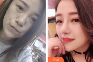 東北國際醫(yī)院整形美容再生醫(yī)學(xué)中心劉曉燕整形價(jià)格表附墊鼻基底案例展示