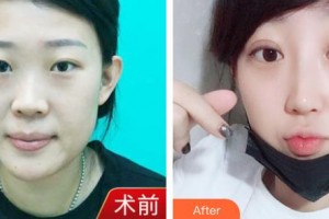東北國(guó)際醫(yī)院整形美容再生醫(yī)學(xué)中心趙新生整形價(jià)格表附鼻部綜合例展示