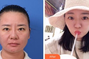 溫嶺整形美容醫(yī)院林寶婉整形價(jià)格表附埋線提升案例展示