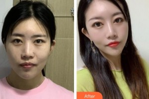 溫嶺整形美容醫(yī)院王光強(qiáng)整形價格表附熱瑪吉案例展示