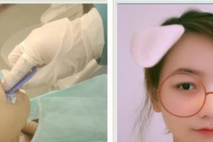 溫嶺口腔醫(yī)院林宣均整形價格表附牙齒隱形矯正案例展示