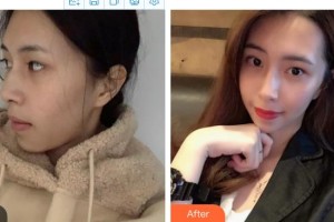 延吉金光善美容醫(yī)院金光善整形價(jià)格表附熱瑪吉案例展示