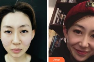 延吉李京云整形美容門診部樸錦錫整形價(jià)格表附埋線提升案例展示