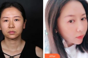 延吉趙美花保健醫(yī)學(xué)美容醫(yī)院金恩華整形價(jià)格表附埋線提升案例展示