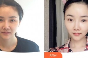 延吉董昌林醫(yī)學美容醫(yī)院李英玉整形價格表附埋線提升案例展示