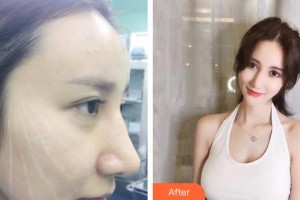 金壇伊曼醫(yī)療美容醫(yī)院李綠水整形價(jià)格表附埋線提升案例展示