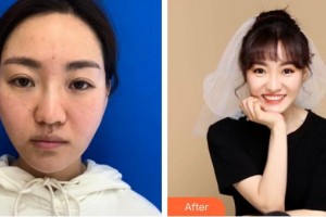 金壇伊曼醫(yī)療美容醫(yī)院夏宏飛整形價(jià)格表附埋線提升案例展示