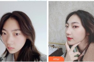 延安大學(xué)附屬醫(yī)院燒傷整形科袁新建整形價(jià)格表附鼻修復(fù)案例展示