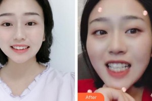 云浮市人民醫(yī)院燒傷整形手外科鐘子敏整形價格表附牙齒隱形矯正案例展示