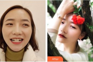 云浮市人民醫(yī)院燒傷整形手外科吳日強整形價格表附牙齒隱形矯正案例展示