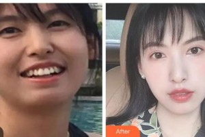 鄧州市第三人民醫(yī)院醫(yī)學美容整形科范喜明整形價格表附金屬托槽矯正案例展示