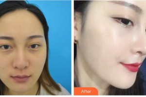 興義時光整形美容醫(yī)院劉自成整形價格表附肋軟骨隆鼻案例展示