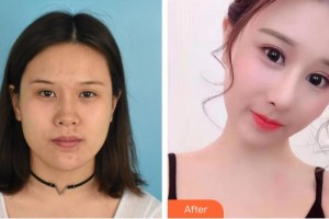 興義時光整形美容醫(yī)院劉彪整形價格表附假體隆鼻案例展示