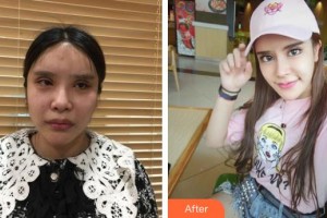 河源曙光醫(yī)療美容門診部崔軍整形價格表附鼻部綜合案例展示