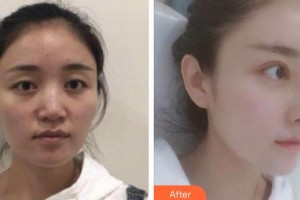 河源曙光醫(yī)療美容門診部石潤整形價格表附假體隆鼻案例展示