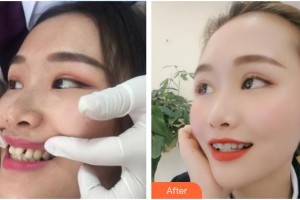 河源曙光醫(yī)療美容門診部白慧媛整形價格表附隱形托槽矯正案例展示