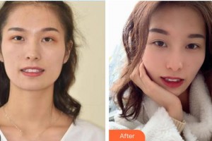 河源拜博東華口腔醫(yī)院王增全整形價格表附美白貼片案例展示