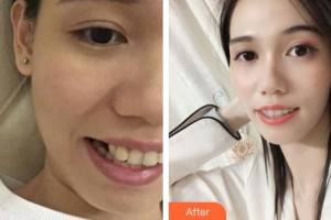 河源市人民醫(yī)院燒傷整形科陳劍平整形價格表附牙齒隱形矯正案例展示