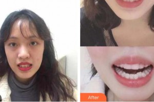 河源拜博東華口腔醫(yī)院黎洪強整形價格表附美白劑美白牙齒案例展示