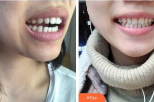 河源曙光醫(yī)療美容門診部許立波整形價格表附牙貼面案例展示