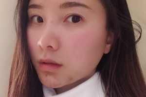 鄭州美立方醫(yī)院怎么樣？熱瑪吉2021價(jià)格分享附案例