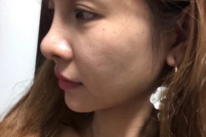 邵逸夫醫(yī)院環(huán)境怎么樣？熱瑪吉價格表和術(shù)后果