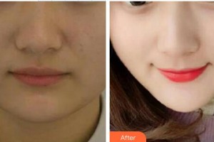 西南醫(yī)科大學附屬醫(yī)院整形燒傷外科蔣曉麗整形價格表附埋線提升案例展示