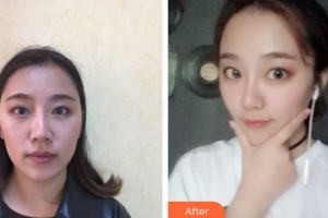 西南醫(yī)科大學附屬中醫(yī)醫(yī)院醫(yī)學美容中心杜宇整形價格表附埋線提升案例展示