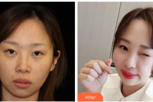 西南醫(yī)科大學附屬醫(yī)院整形燒傷外科丁曉斌整形價格表附熱瑪吉案例展示