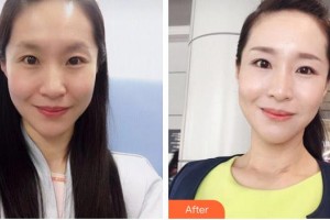 瀏陽(yáng)康美醫(yī)療美容門(mén)診部鄒笑寒整形價(jià)格表附嗨體去頸紋案例展示