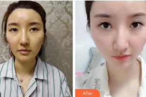 瀏陽(yáng)康美醫(yī)療美容門(mén)診部杜亞妮整形價(jià)格表除皺案例展示