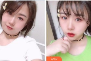 張波整形價(jià)格表附埋線提升案例展示