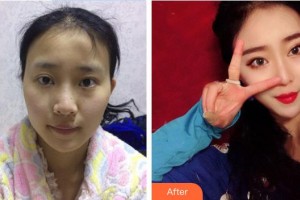 王衡健整形價(jià)格表附鼻部綜合案例展示