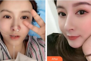 任向群整形價(jià)格表附低山根鼻翼肥案例展示