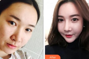 戴玉琳整形價(jià)格表附自體軟骨墊鼻尖案例展示