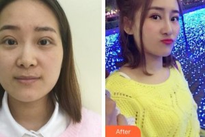 整形價(jià)格表附鼻部綜合案例展示