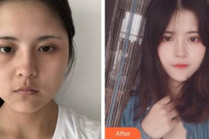 整形價(jià)格表附鼻部綜合案例展示