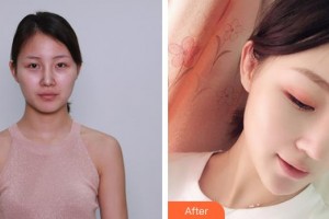 溧陽(yáng)智多星醫(yī)療美容門(mén)診部聶烽整形價(jià)格表附埋線提升案例展示