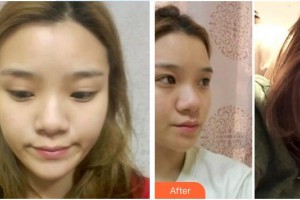 渭南海成皮膚專(zhuān)科醫(yī)院韓海成整形價(jià)格表附熱拉提案例展示