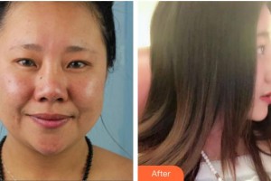 渭南市臨渭區(qū)衛(wèi)生學(xué)校附屬醫(yī)院整形激光美容科胡遠(yuǎn)征整形價(jià)格表附埋線提升案例展示