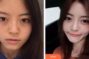 浦江縣亞芳皮膚美容整形門(mén)診部陳燕鶯住院醫(yī)師整形價(jià)格表附埋線提升案例展示