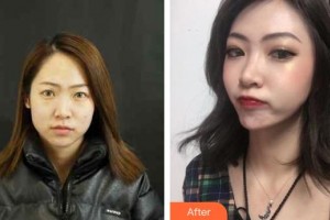 中山愛(ài)思特美容醫(yī)院　張朝凱整形價(jià)格表附鼻部綜合案例展示