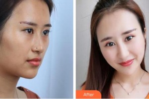 揭陽(yáng)華美整形美容醫(yī)院魯利兵整形價(jià)格表附超聲波潔牙案例展示