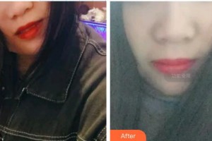 廣水市第一人民醫(yī)院整形外科吳禮輝整形價(jià)格表附牙齒隱形矯正案例展示