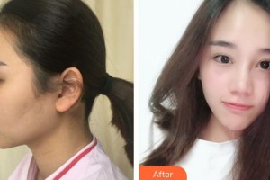 侯馬晨暉醫(yī)學(xué)美容門(mén)診部李晉才整形價(jià)格表附埋線提升案例展示