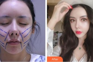 上虞市人民醫(yī)院整形科丁帆整形價(jià)格表附埋線提升案例展示