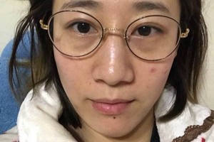 北京大學(xué)第一醫(yī)院皮膚科激光祛斑怎么樣附果圖